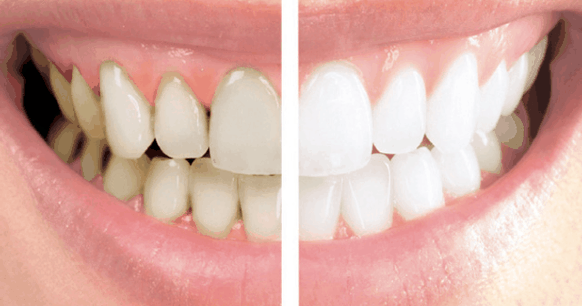 rotación Misterioso al menos 3 productos caseros que puedes usar para eliminar el sarro de tus dientes