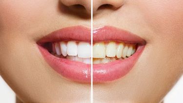 Frotar estas dos cosas en tus dientes hará que se vean más blancos
